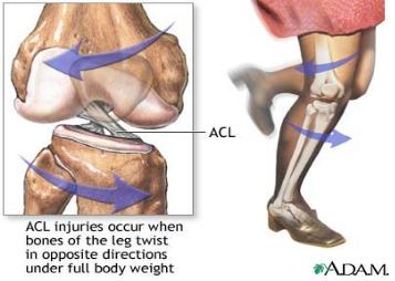 스포츠 손상 및 재활 - 무릎 손상에 대한 정보